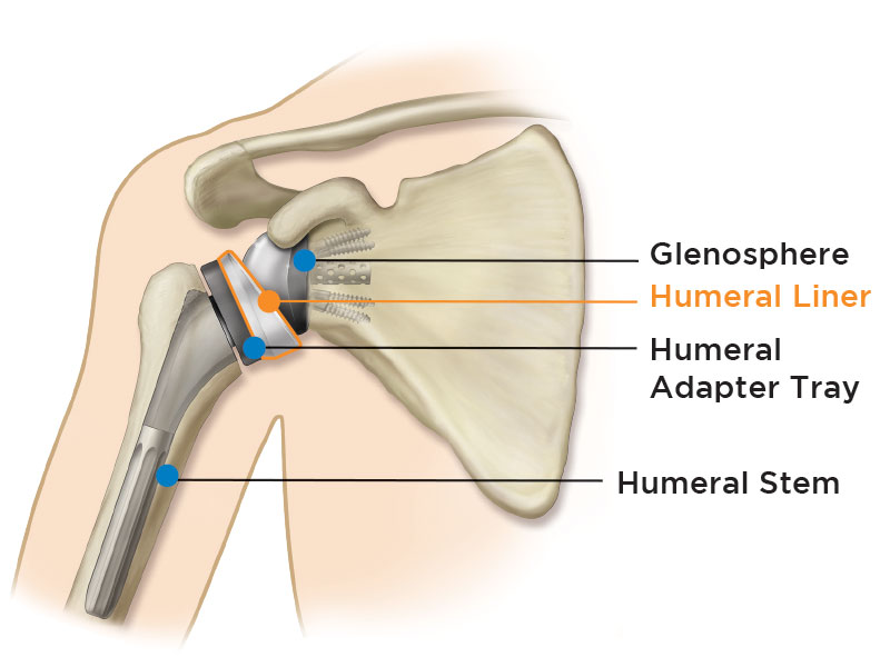 Reverse Shoulder Replacement